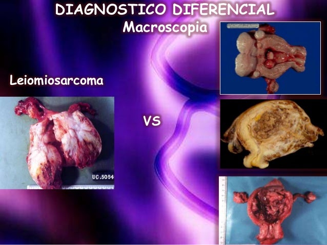 leiomiosarcoma uterino
